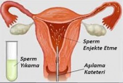 Aşılama tedavisi nedir (İntrauterin İnseminasyon) (IUI) Aşılama tedavisi nedir (İntrauterin İnseminasyon) (IUI)