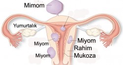 Miyom (Myoma Uteri) nedir