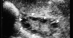 Polikistik Over Sendromu (PCOS, PKOS) Polikistik Over Sendromu (PCOS, PKOS)