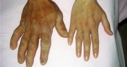 Akromegali (Kontrolsüz büyüme hastalığı) nedir?