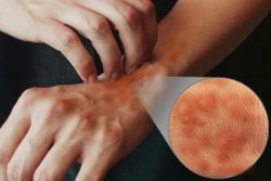 Anaflaksi (Alerjik şok) Nedir Nedenleri ve Belirtileri Anaflaksi (Alerjik şok) Nedir Nedenleri ve Belirtileri