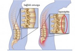 Ankilozan spondilit hastalığı nedir ve tedavisi