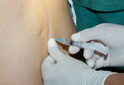 Ağrısız normal doğum (Epidural analjezi) (Prenses doğum)