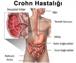Crohn hastalığı ve tedavisi Crohn hastalığı ve tedavisi