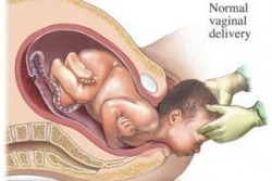 Epizyotomi (Doğum kesisi) Dikişli doğum