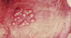 Genital siğil (Kondilom) Nedir, Tedavisi ve Alınacak önlemler