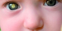 Göz tümörü (Retinoblastom) nedir belirtileri nelerdir? Göz tümörü (Retinoblastom) nedir belirtileri nelerdir?