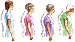 Kemik erimesi (Osteoporoz) nedir? Kemik erimesi (Osteoporoz) nedir?