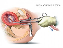 Kürtaj nedir, Nasıl yapılır Kürtaj nedir, Nasıl yapılır