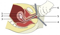 Kürtajda parça kalması nedir, belirtileri nelerdir? Kürtajda parça kalması nedir, belirtileri nelerdir?