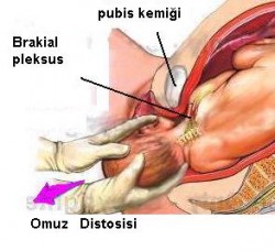 omuz distosisis