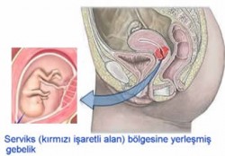 rahim ağzı gebeliği