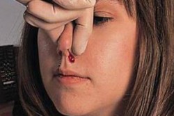 Burun kanaması nasıl geçer?