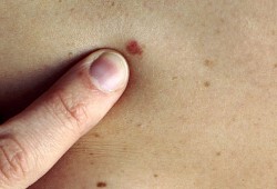 Deri (cilt) kanseri nedir çeşitleri tipleri nelerdir