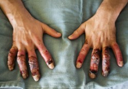 Karl Zebarth, shows off his severe frostbite of the hands he got on New years Eve, at the burn unit at Sunnybrook Hospital in Toronto on Thursday, January 9, 2014. THE CANADIAN PRESS/Nathan Denette