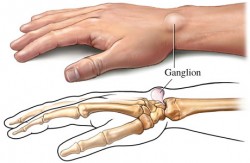 ganglion nedir nasıl tedavi edilir