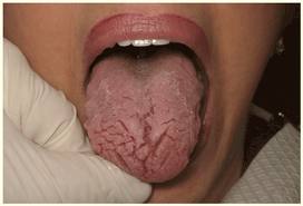 dil çatlaması