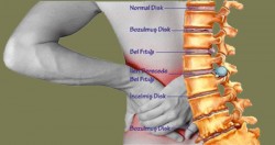 Disk kayması nedir, belirtileri ve tedavisi