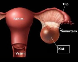 Folikül kisti belirtileri nedenleri ve tedavisi Folikül kisti belirtileri nedenleri ve tedavisi