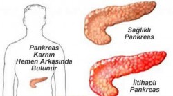 Pankreas iltihabı (pankreatit) belirtileri ve tedavisi