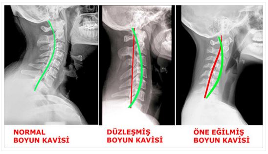 boyun düzleşmesi