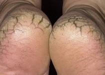 Topuk çatlakları nedenleri ve çözümü Topuk çatlakları nedenleri ve çözümü