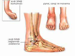 ayak bileği burkulması