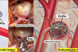 Beyinde anevrizma belirtileri nelerdir tedavisi nasıl yapılır?