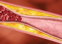 Yüksek Trigliserid Nasıl Düşürülür: Etkili Yöntemler ve İpuçları Yüksek Trigliserid Nasıl Düşürülür: Etkili Yöntemler ve İpuçları
