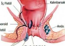 Basur İçin Zararlı Gıdalar ve Maddeler Basur İçin Zararlı Gıdalar ve Maddeler