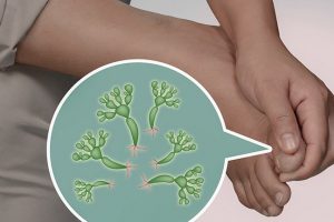 Mantar enfeksiyonları tedavisi için 8 pratik ve etkili tavsiye