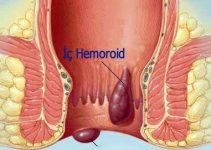 Hemoroid (Basur) ve anal fissür (Makatta çatlak)
