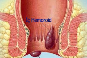 Hemoroid (Basur) ve anal fissür (Makatta çatlak)