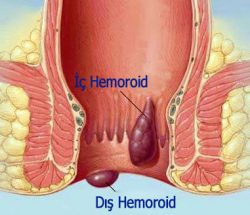 hemoroid-ve-fissur
