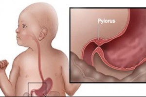Pilor Stenozu nedir, neden olur?