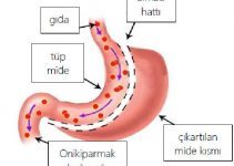 Mide küçültme ameliyatı nedir, nasıl yapılır? Mide küçültme ameliyatı nedir, nasıl yapılır?