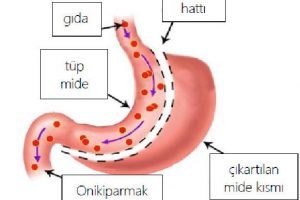 Mide küçültme ameliyatı nedir, nasıl yapılır?