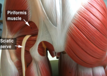 Piriformis sendromu ve siyatik ağrısı hakkında