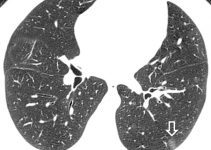 Akciğerde nodül neden olur, Pulmoner nodül nedir? Akciğerde nodül neden olur, Pulmoner nodül nedir?