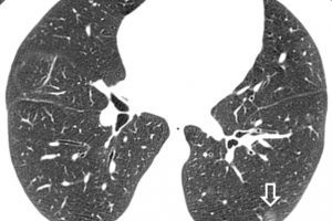 Akciğerde nodül neden olur, Pulmoner nodül nedir?