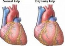 Kalp büyümesi (kardiyomegali) neden olur, belirtileri nelerdir?