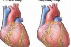 Kalp büyümesi (kardiyomegali) neden olur, belirtileri nelerdir?