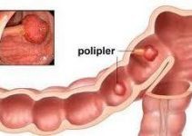 Polip nedir, Polip belirtileri tanısı ve tedavisi Polip nedir, Polip belirtileri tanısı ve tedavisi