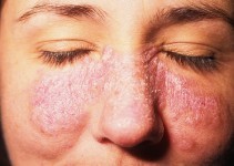 Lupus Hastalığı Nedir Lupus Hastalığının Belirtileri ve Nedenleri