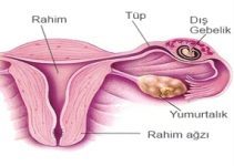 Dış gebelik nedir, nasıl tedavi edilir?