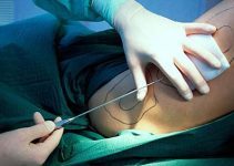 Karın estetiği ve yağ aldırma işlemi (Liposuction) Karın estetiği ve yağ aldırma işlemi (Liposuction)