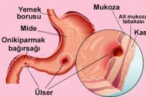 Ülser nedir neden olur?