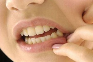 Aft (Ağız yarası) Nedenleri Nelerdir?