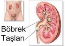 Böbrek Taşı Nasıl Düşer? Böbrek Taşı Nasıl Düşer?