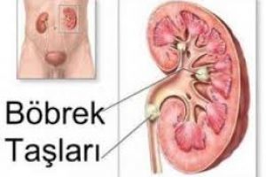 Böbrek Taşı Nasıl Düşer?